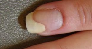 Расслоение ногтей: причины появления и способы лечения