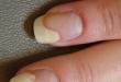 Расслоение ногтей: причины появления и способы лечения