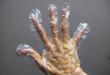 Сухость кожи рук — причины, лечение